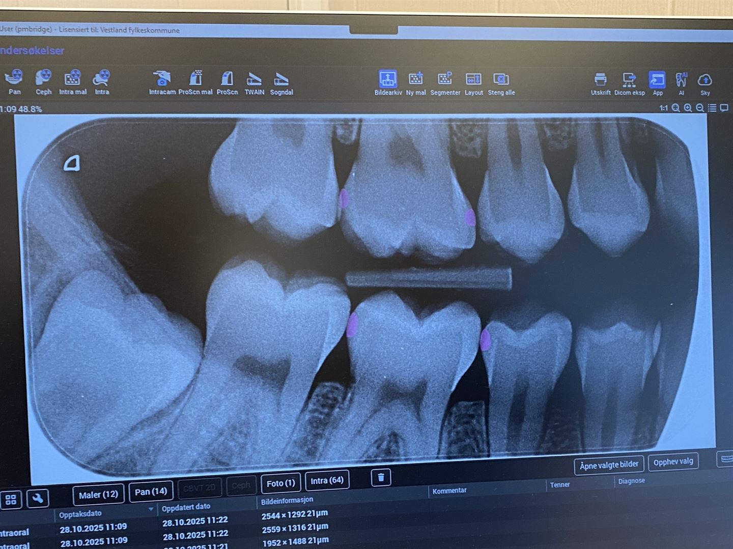røntengenbilete av tenner